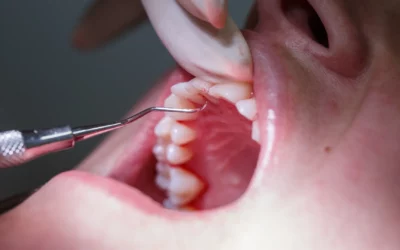 Parodontite a Torino: Come Riconoscerla e Curarla Definitivamente